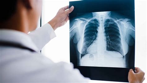 Thoracic Spine X-Ray: Diagnosing Spinal Conditions