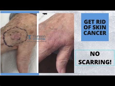 Superficial Radiation Therapy – Skin Cancer Treatment - YouTube