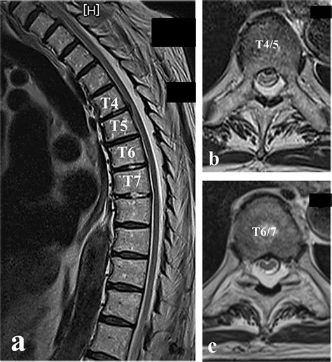 Mri Thoracic Spine Bulging Disc | sexiezpix Web Porn