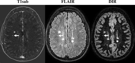 Non-Contrast MRI is Effective in Monitoring MS Patients