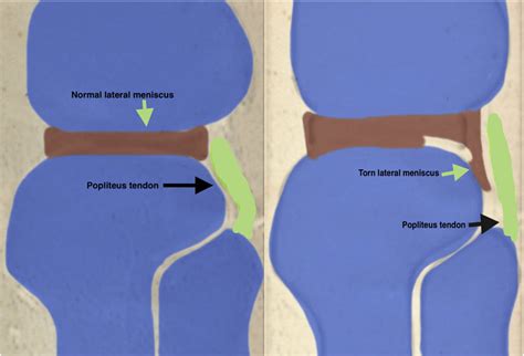 Illustration of displaced flap tear of posterior horn of lateral ...