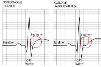 38. Primary and secondary repolarization abnormalities in the ECG ...