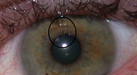 Corneal Erosion | Warwar Eye Group