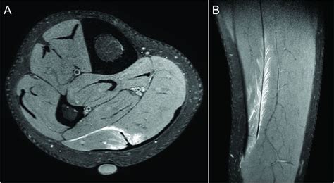 Connective tissue injury in calf muscle tears and return to play: MRI ...