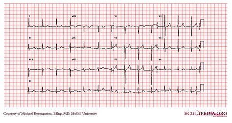 First degree AV block EKG examples - wikidoc