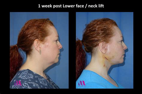 Lower face / neck lift – A M Aesthetic Surgery