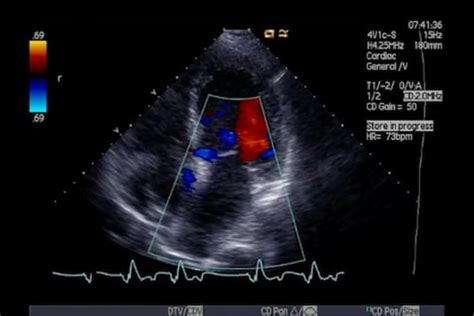 Ultrasound Doppler: Principles, Preparation, Results and more