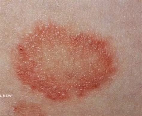 Gallery For > Nummular Eczema Vs Ringworm