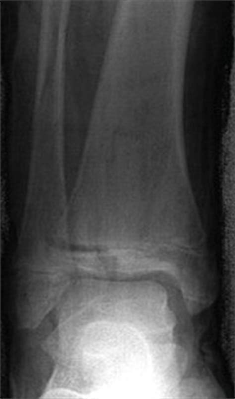 Fracture Education : Evaluation