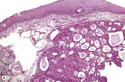 Tumors of the conjunctiva | Basicmedical Key