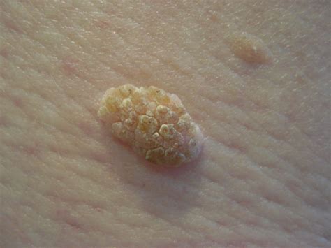 Seborrheic Keratosis Treatment Glasgow | Ever Clinic