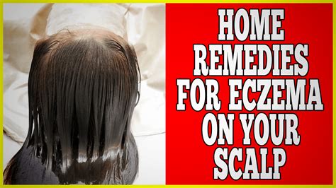 Home Remedies For Eczema On Scalp - Clinton Conley