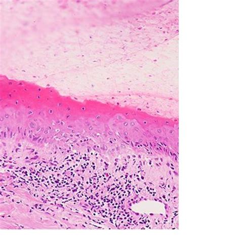 Lateral longitudinal nail biopsy showing a dense band-like lymphocytic ...