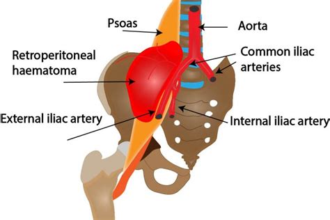 Retroperitoneal Hematoma Ultrasound