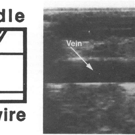 Ultrasound of the left subclavian vein with the needle entering the ...