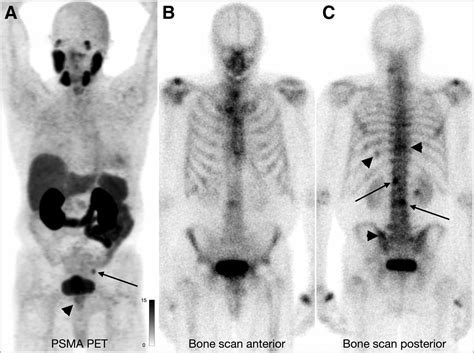 PSMA PET Outperforms Bone Scans in Prostate Cancer Staging - Axis ...