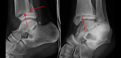 Fracture Patterns in Triplane Fractures | Orthopedics This Week