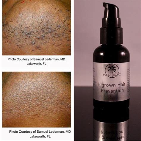 PureTropix: Ingrown hair Prevention