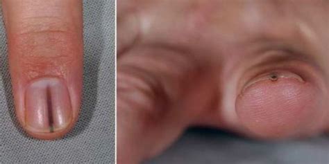 'Splinter' Under Man's Nail Turns Out To Be Tumor (PHOTO) | HuffPost Life