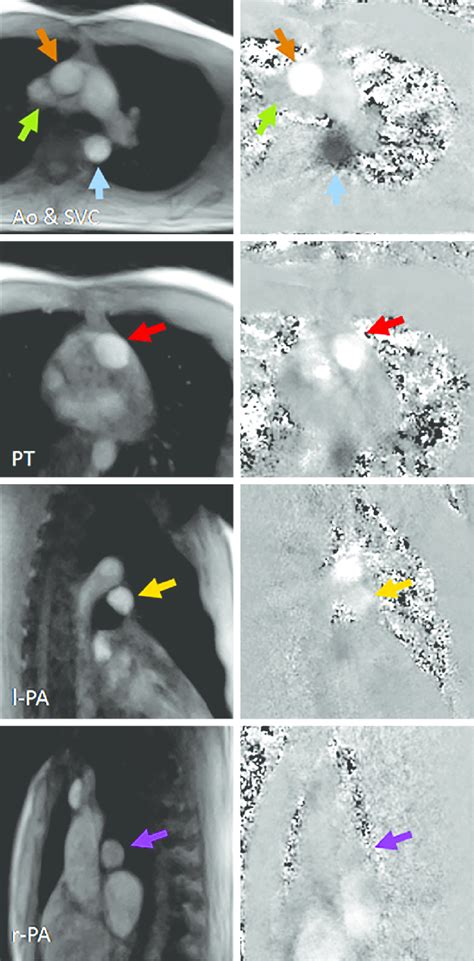 Real-time phase-contrast flow MRI (3 T, 40 ms): magnitude images and ...