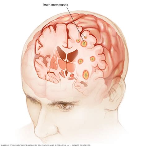 Metástasis cerebral - Síntomas y causas - Mayo Clinic