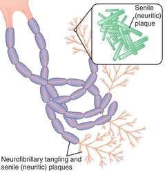 Neurofibrillary tangles | definition of neurofibrillary tangles by ...