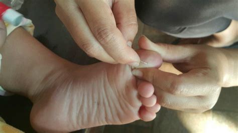 How To Remove A Splinter In 11 Natural And Painless Ways