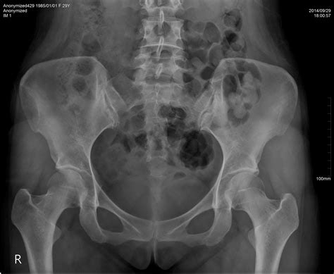 Pelvic X Ray Lines : Pelvis AP X-ray of 66-year-old female. White arrow ...