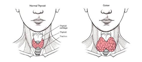 Multinodular Goiter - Sackidthyroid