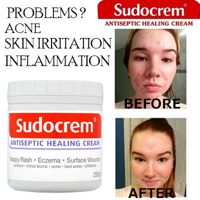 Qoo10 - Sudocrem Antiseptic Healing Cream 125g - Nappy Rash / Eczema ...