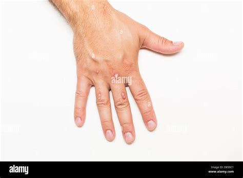 Cryosurgery hi-res stock photography and images - Alamy