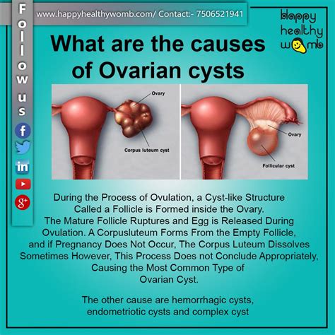 Can Complex Ovarian Cysts Cause Thyroid Problems – Coach M Morris