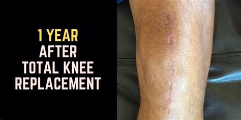 1 Year After Knee Replacement Surgery | 12 Months Of Healing