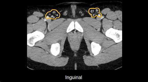 Inguinal Lymph Nodes Abdomen