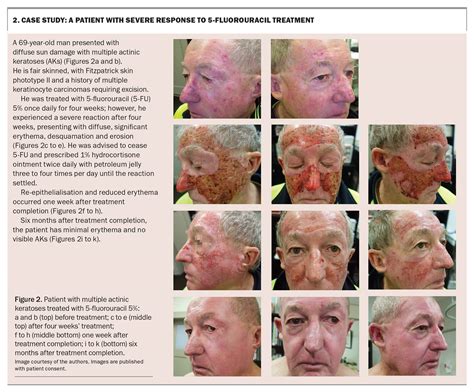 Actinic keratoses – a guide to treatment with 5-fluorouracil cream ...