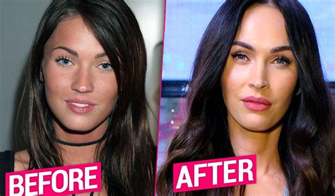 Megan Fox Plastic Surgery Transformation Revealed By Top Doctors