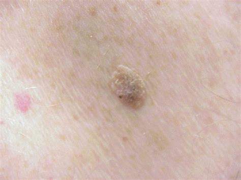 seborrheic keratosis - pictures, photos