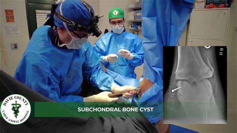 DCLAH Services - Subchondral Bone Cyst Surgery - YouTube