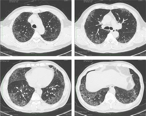 High-resolution computed tomography findings. Chest computed tomography ...