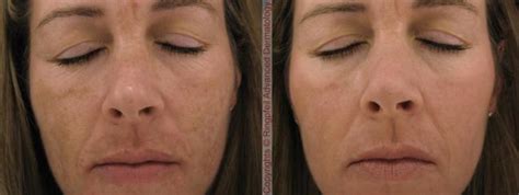 Melasma Hyperpigmentation Treatment, PA | Melasma Removal, Philadelphia