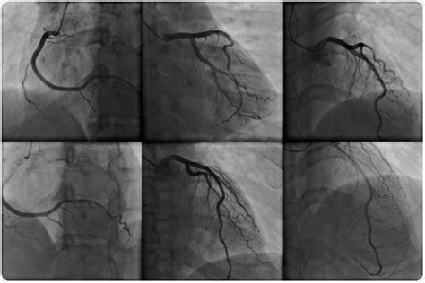 What is Angiography?