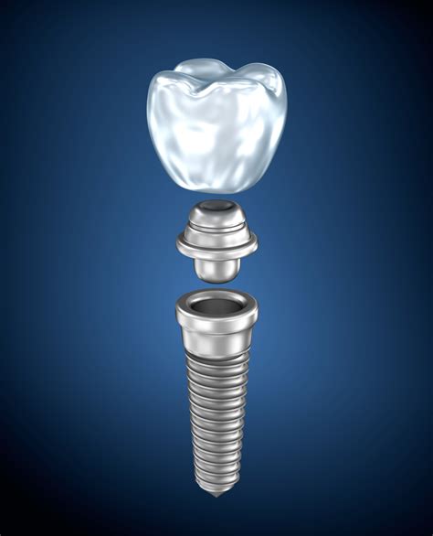 Dental titanium implant - Weldon Dentistry Blog