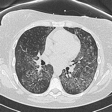 diffuse Alveolarblutung | pacs