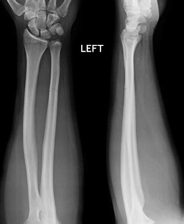 Fracture Shaft Of Radius Ulnar Bone Xray Film Stock Photo - Download ...