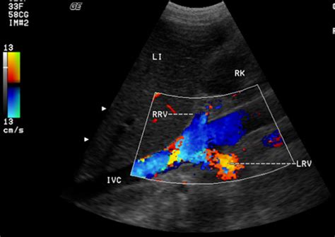 Ultrasound localization of the inferior vena cava and renal vein. IVC ...