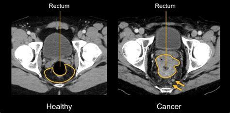 Abdominal CT: lymph nodes • LITFL • Radiology Library