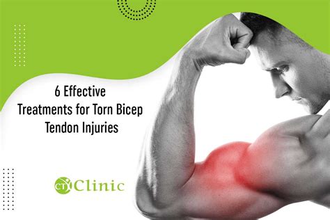 6 Effective Treatments for Torn Bicep Tendon Injuries - CT Clinic