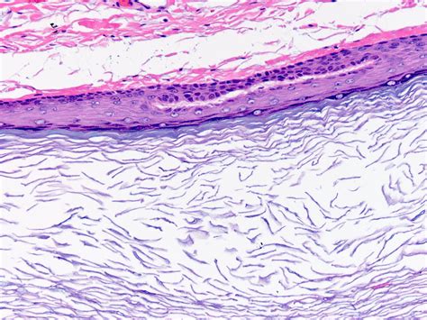 Epidermal Inclusion Cysts Eic Epidermoid Cysts