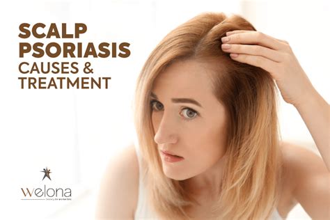 Scalp Psoriasis: Causes and Treatment