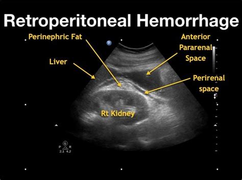 Retroperitoneal hematoma – NephroPOCUS